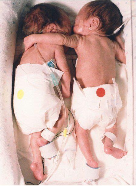 NICU infant twins hugging each other
