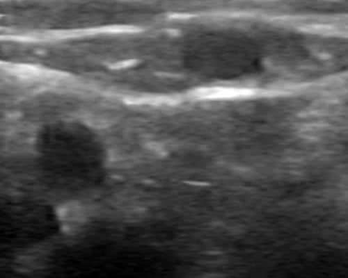 iv-ultrasound-1.jpg.ea31f5a1e00c9207829f5d80620c4667.jpg