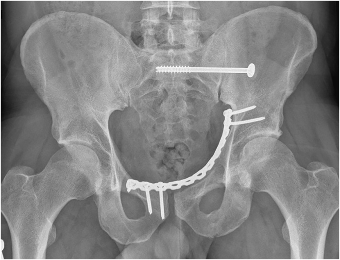 AP-pelvis-X-ray-3-months-status-post-open-reduction-internal-fixation.thumb.png.0e813053d0317c8df27abebe0c013549.png