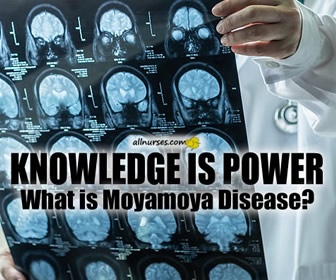 Have you cared for a patient with Moyamoya disease?  What was your experience?