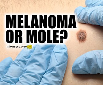 Melanoma or Mole?