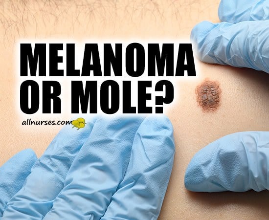 Melanoma or Mole?
